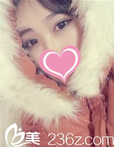 在廊坊華康花4380元做韓式雙眼皮后由內(nèi)雙變魅力大眼