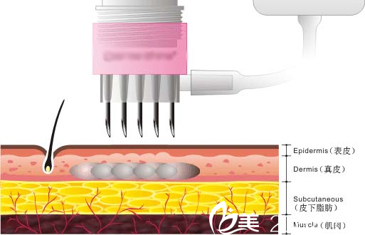可以穿透皮膚表皮層將營養(yǎng)液輸送至真皮層