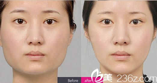 面部輪廓整形案例圖