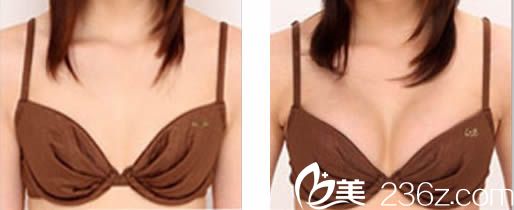 假體隆胸前后對比圖
