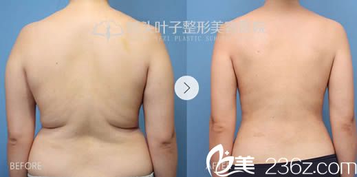 腰腹吸脂前后對比效果