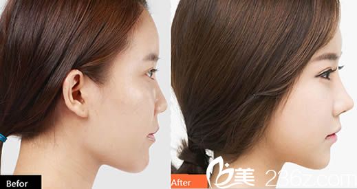 達(dá)拉斯隆鼻前后對比效果