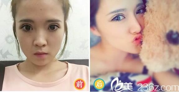 馬文章醫(yī)生的玻尿酸隆鼻<span style= 馬文章醫(yī)生的玻尿酸隆鼻<span style=