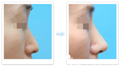 深圳非凡韓國醫(yī)生李寒松鼻子整形案例