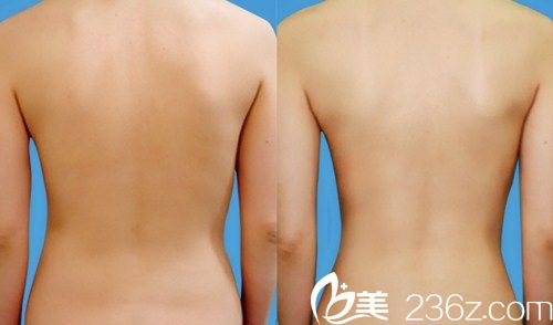 韓國江南三星整形醫(yī)院   背部吸脂前后對比圖