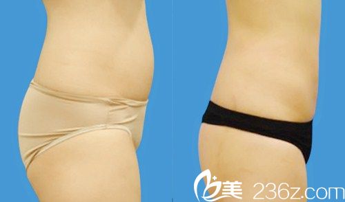 韓國江南三星整形醫(yī)院   腹部吸脂前后對比圖