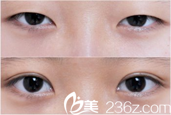 雙眼皮與單眼皮的區(qū)別