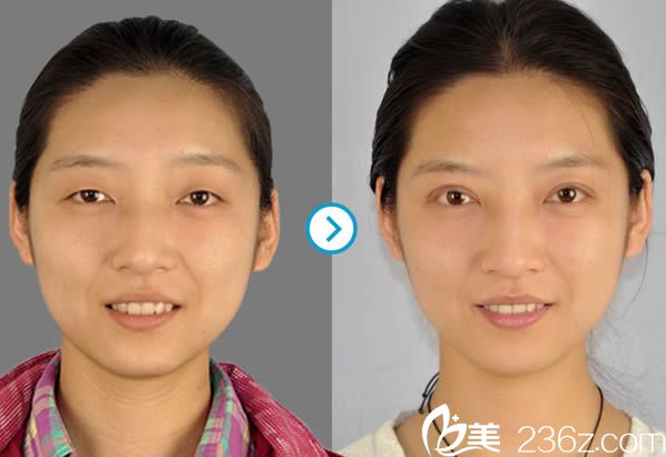 馮守運(yùn)雙眼皮案例圖 馮守運(yùn)雙眼皮案例圖