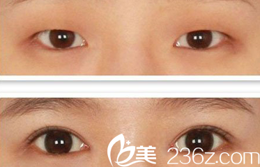 雙眼皮整形前后對比案例