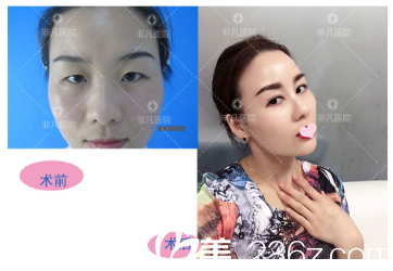 深圳非凡整形醫(yī)院易培金雙眼皮案例 深圳非凡整形醫(yī)院易培金雙眼皮案例