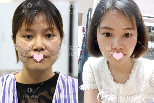 深圳非凡整形醫(yī)院王永祥面部線雕提升案例 深圳非凡整形醫(yī)院王永祥面部線雕提升案例