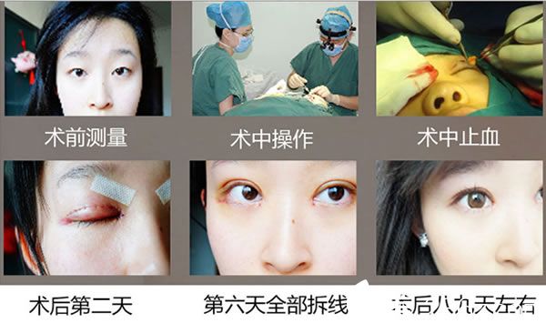 壹加壹分切雙眼皮手術(shù)過程 壹加壹分切雙眼皮手術(shù)過程