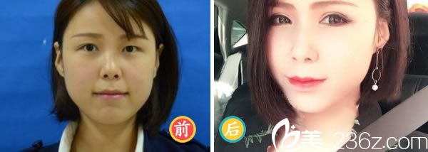 壹加壹雙眼皮手術(shù)<span style= 壹加壹雙眼皮手術(shù)<span style=