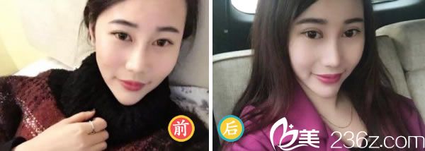 全切雙眼皮50天的恢復(fù)<span style= 全切雙眼皮50天的恢復(fù)<span style=