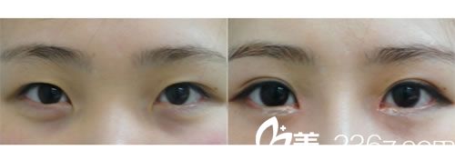 內(nèi)雙變外雙前后對(duì)比圖 韓國(guó)江南三星整形外科 內(nèi)雙變外雙前后對(duì)比圖 韓國(guó)江南三星整形外科