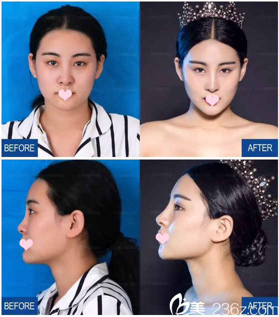 廣州海峽隆鼻手術(shù)超好看