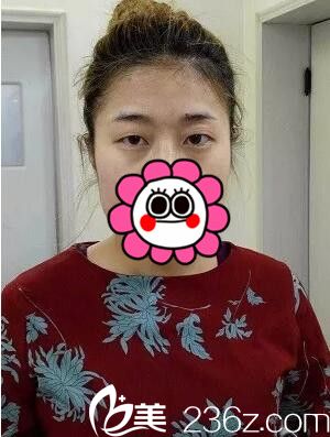 術(shù)前樣貌 術(shù)前樣貌