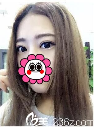 術(shù)后化妝效果 術(shù)后化妝效果