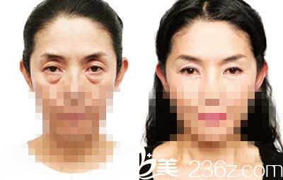 祛眼袋前后對(duì)比圖 祛眼袋前后對(duì)比圖