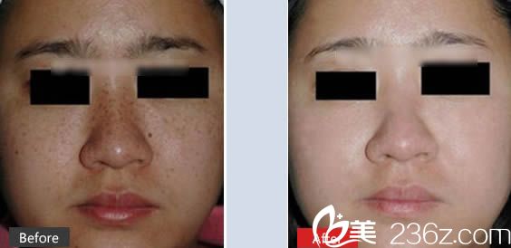 閆侯旺祛斑前后對比案例 閆侯旺祛斑前后對比案例
