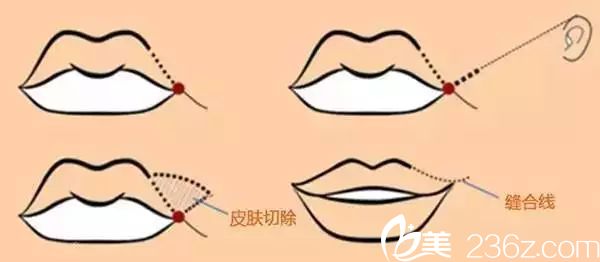 微笑唇是手術(shù)方法有兩種埋線提拉法