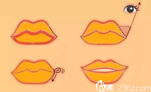 埋線提拉是將嘴角多余的皮膚去除，用線縫合