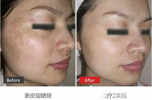 王瑩治療曬斑案例效果對比圖 王瑩治療曬斑案例效果對比圖
