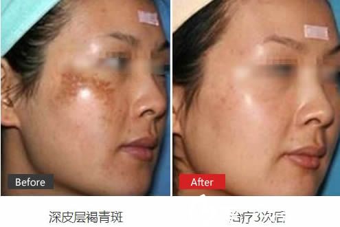 王瑩治療深皮層褐青斑3次術后效果圖 王瑩治療深皮層褐青斑3次術后效果圖