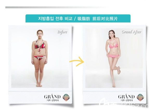 高蘭得整形外科   吸脂前后對(duì)比圖