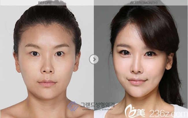 高蘭得整形外科   面部輪廓前后對(duì)比圖