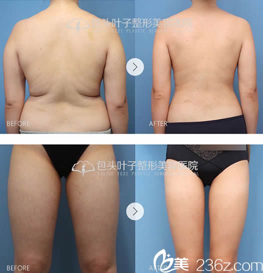 腰腹部和腿部吸脂瘦身案例圖
