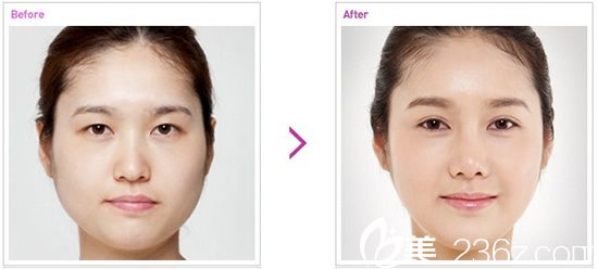 開眼角和雙眼皮整形手術(shù)前后對比照片 開眼角和雙眼皮整形手術(shù)前后對比照片