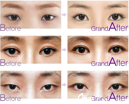  放低眼角手術(shù)前后對比照片