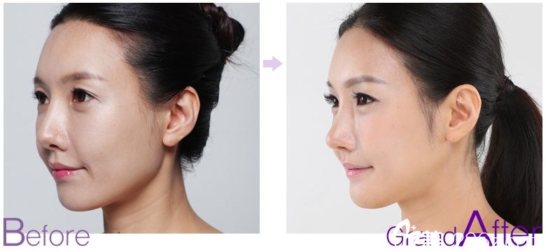 鼻子修復(fù)前后對(duì)比圖