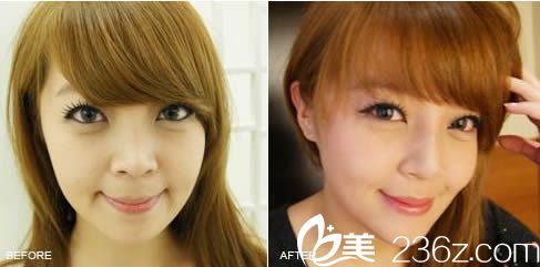 在包頭麗人做膨體隆鼻前后對比效果圖 在包頭麗人做膨體隆鼻前后對比效果圖