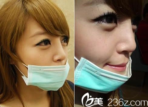 看我在包頭麗人掏3.5萬做膨體隆鼻+自體軟骨墊鼻尖效果好不好