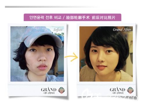 面部輪廓手術(shù)對比圖 面部輪廓手術(shù)對比圖