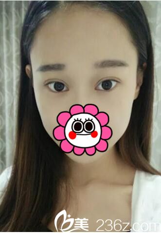 武漢美立方胡江偉全切雙眼皮35天恢復案例圖 看得見的才是好效果