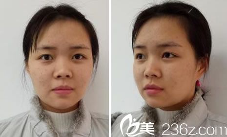 在瑞麗做鼻綜合前的素顏照片