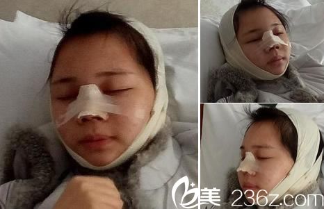 做完鼻綜合手術(shù)當(dāng)天照片