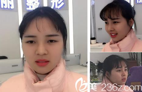 耳軟骨隆鼻手術(shù)15天效果