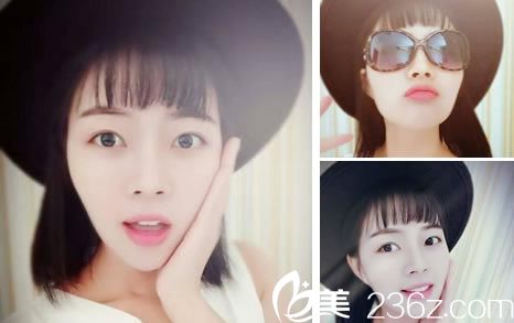 自體軟骨隆鼻手術(shù)60天恢復(fù)照片