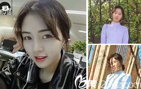 鼻綜合整形手術(shù)80天效果怎么樣