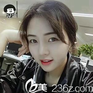 金華瑞麗整形好嗎？【真人案例】鄰家小妹分享做鼻綜合80天效果與恢復過程圖