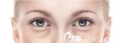 常見眼袋類型之一松弛型眼袋
