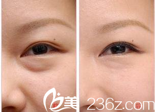 不手術(shù)不開刀的激光祛眼袋法