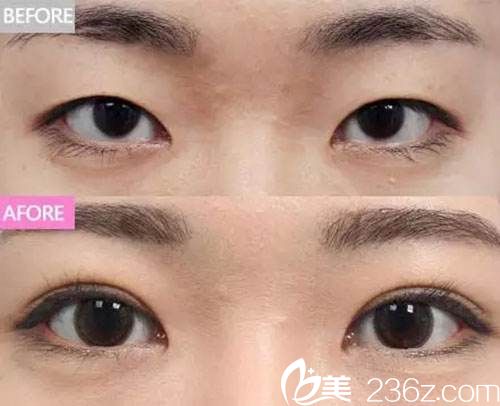 雙眼皮手術改善倒睫