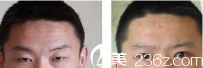 雙眼皮可改善抬頭紋