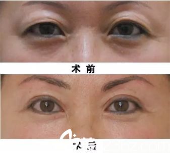 雙眼皮手術緊致眼部皮膚