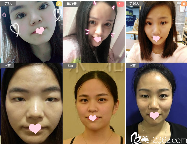 深圳米蘭柏羽朱武根切開(kāi)雙眼皮案例展示 深圳米蘭柏羽朱武根切開(kāi)雙眼皮案例展示